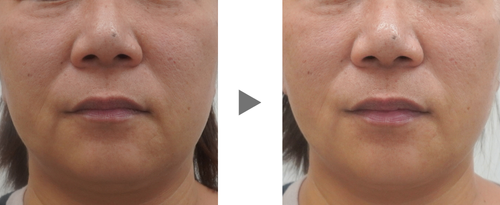 ビューティジェットあご症例