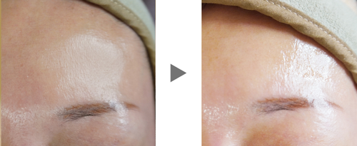 ビューティジェットでこ症例