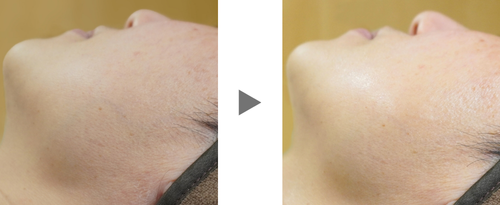 ビューティジェット顔症例