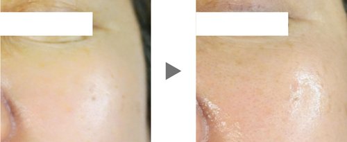 ビューティジェット目症例