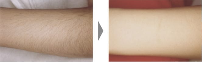 パワーライトの腕の脱毛症例